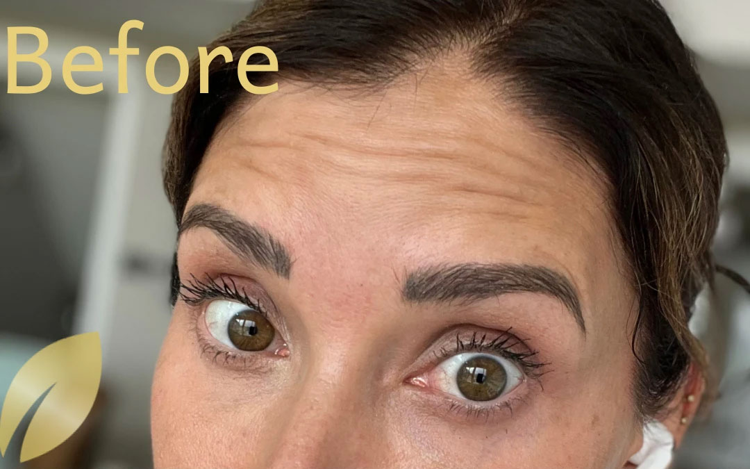 Neurotoxin - Before