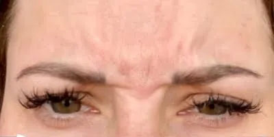 Neurotoxin - Before