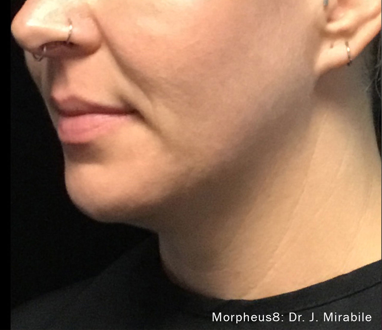 Morpheus8 - After