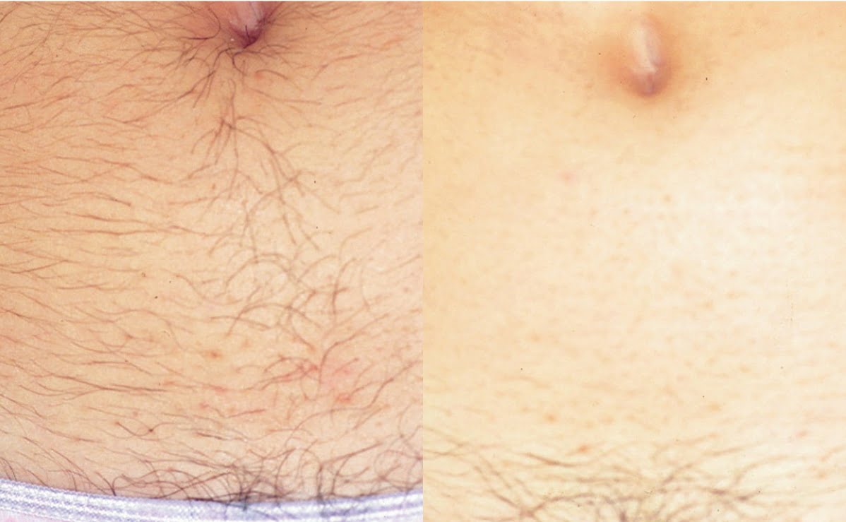 HY-Before-and-After-B2C-41 (1)