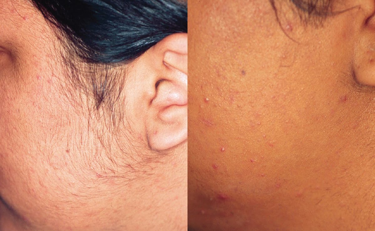 HY-Before-and-After-B2C-42 (1)