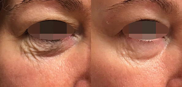 Opus-Before-and-After-B2B-1-1