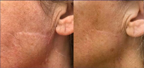 Opus-Before-and-After-B2B-2