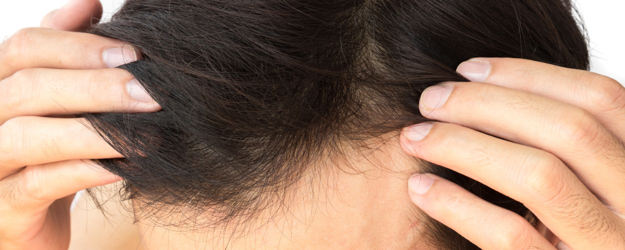 bnr-pic-image-alma-ted-hair-restoration-refresh2 Botox Injection, Refresh Aesthetics