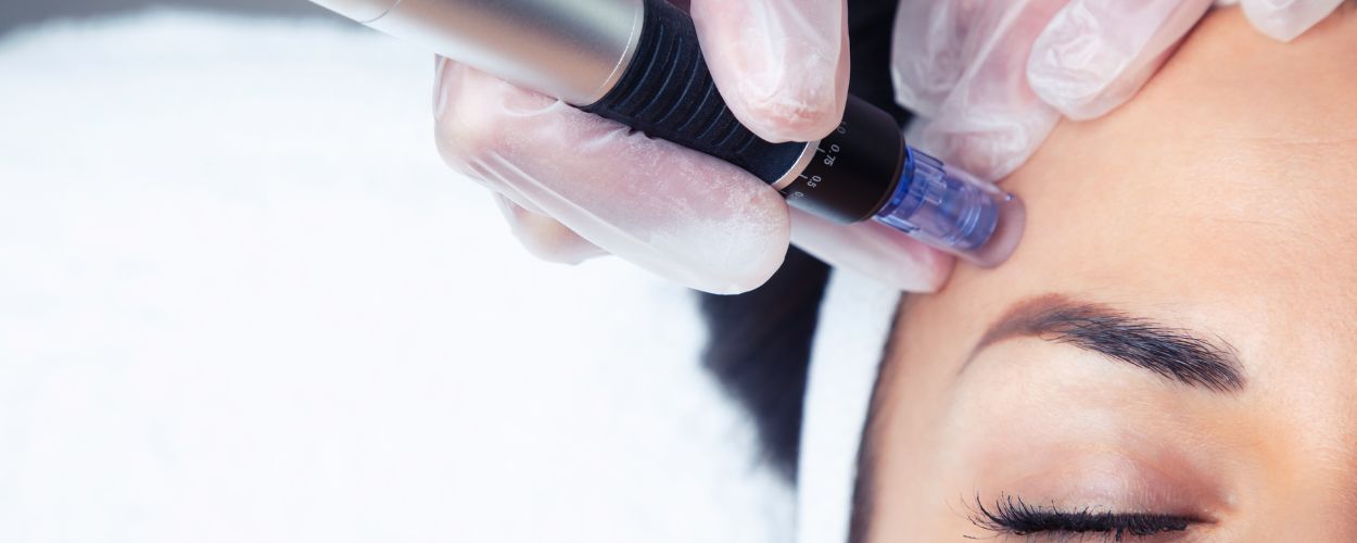 bnr-pic-image-microneedling-refreshaesthetics2