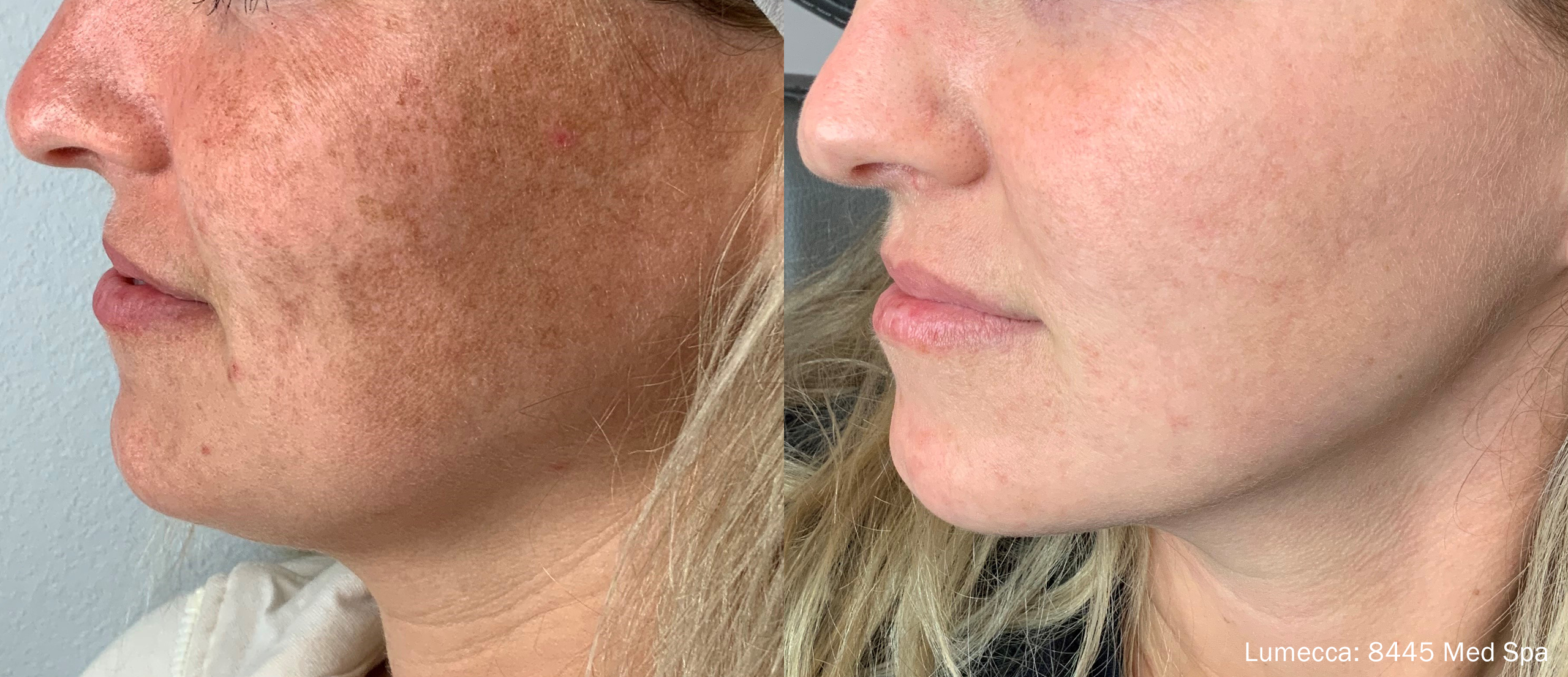 lumecca-before-after-8445-med-spa-preview-1 (1)
