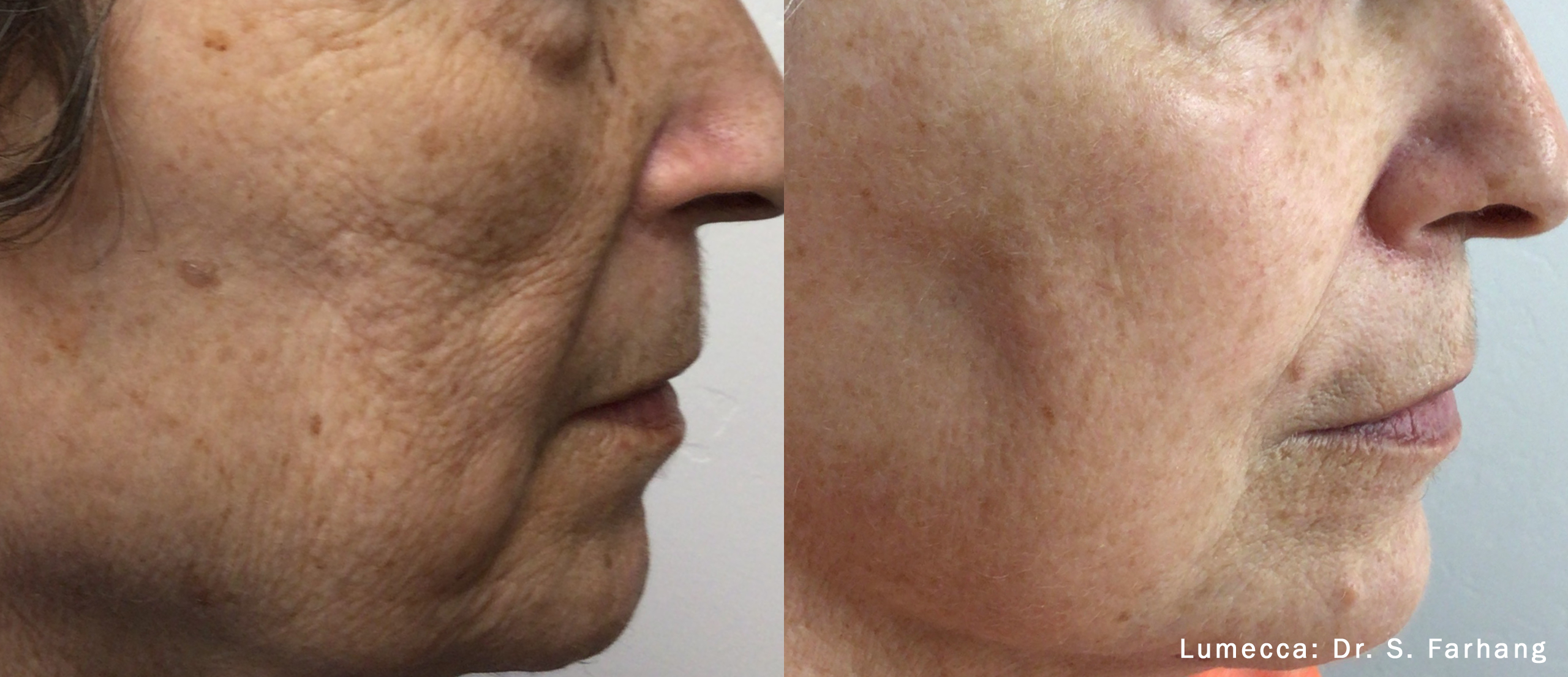 lumecca-before-after-dr-s-farhang-preview-1 (1)