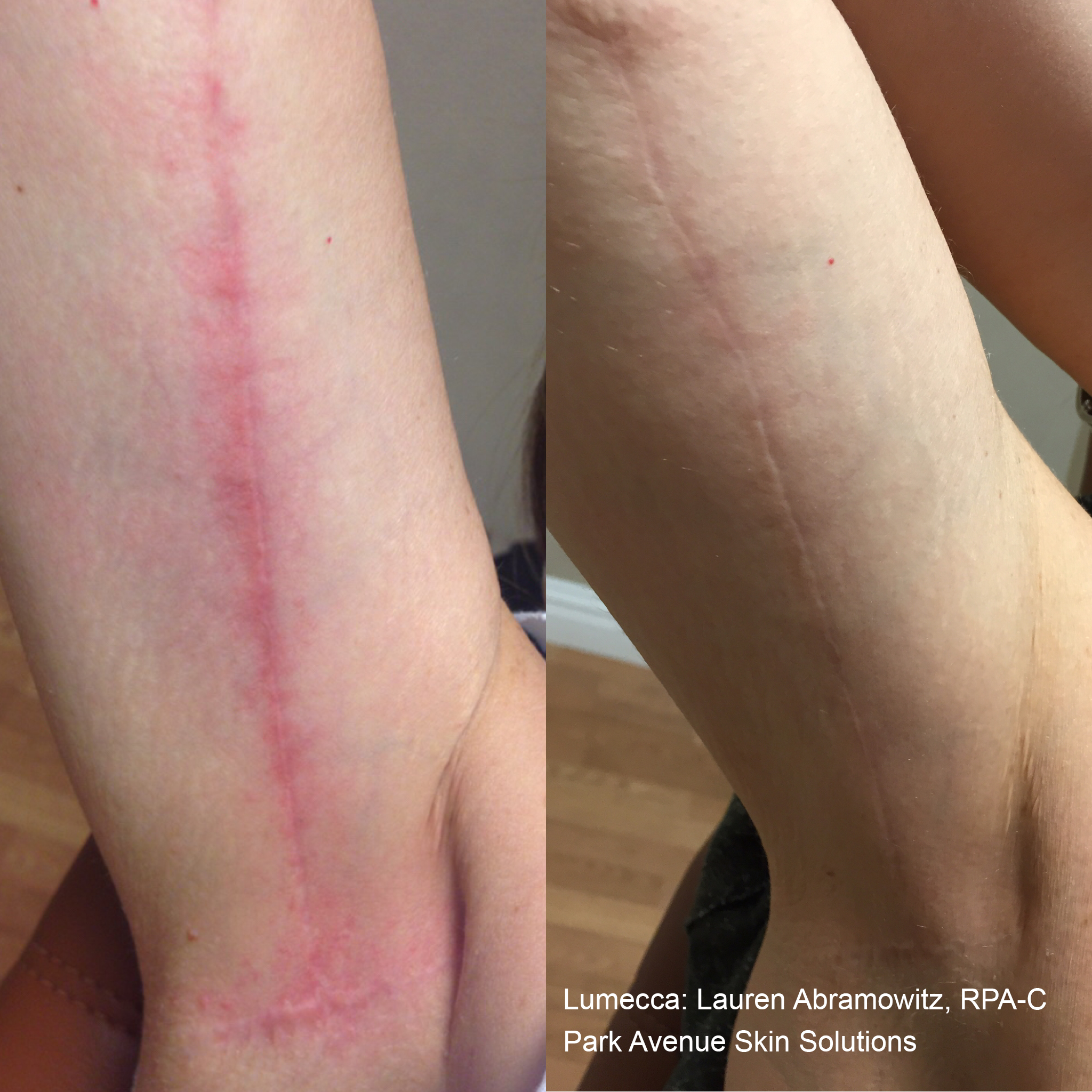 lumecca-before-after-lauren-abramowitz-rpa-c-park-avenue-skin-solutions-preview-1 (1)
