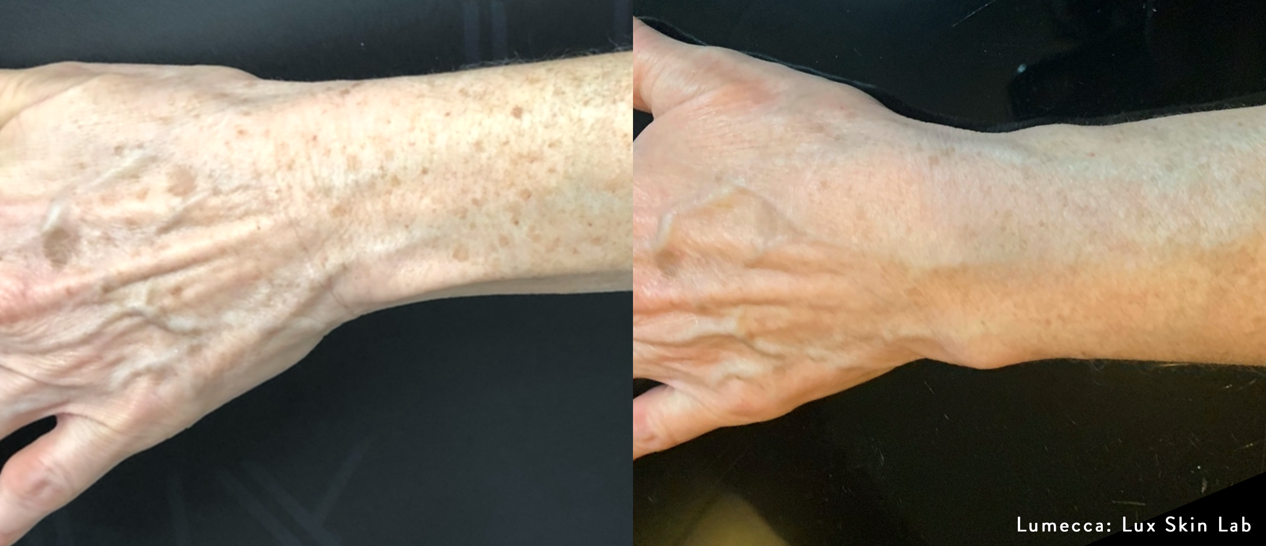 lumecca-before-after-lux-skin-lab-preview-2 (1)