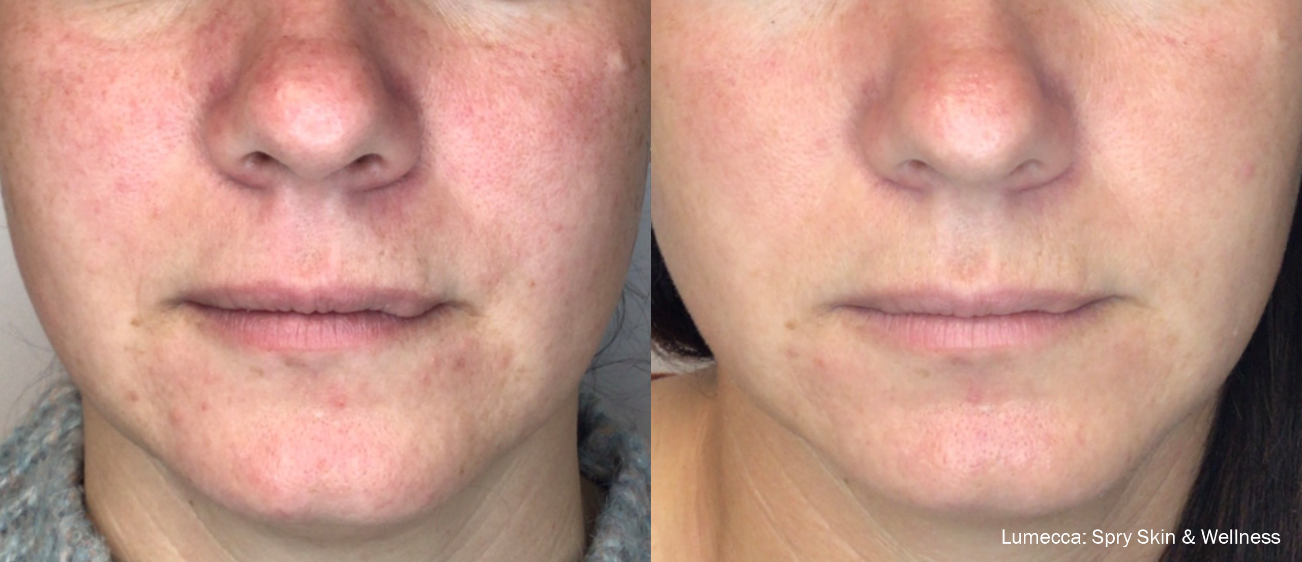 lumecca-before-after-spry-skin-and-wellness-preview-3 (1)