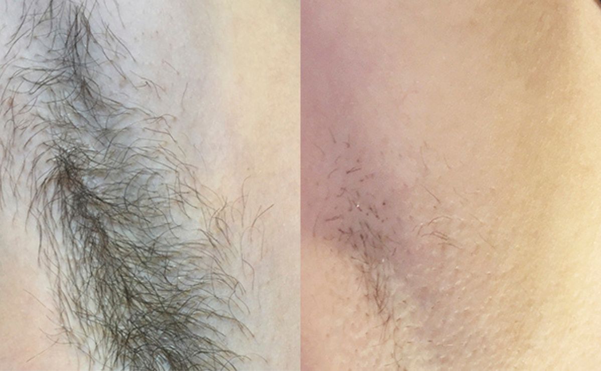 pic-image-beforeafter-fusion