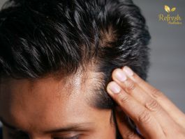 pic-image-refresh-prf-hair-restoration