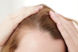 womens hair loss solutions