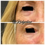 Clear Lift Before and After Ridgeline Aesthetics