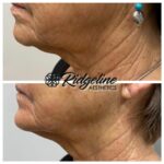 Clear Lift Before and After - Ridgeline Aesthetics