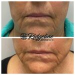 Clear Lift Before and After Ridgeline