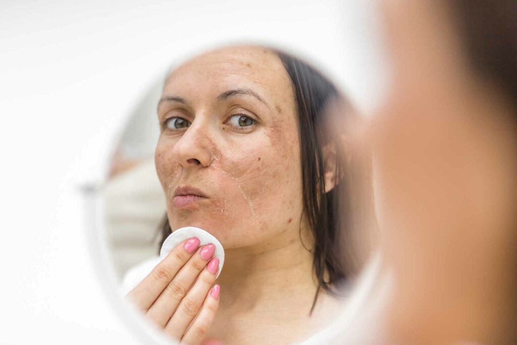 Skin resurfacing