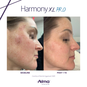 Treat Melasma, Even Skin Tone