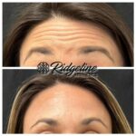 Wrinkle Removal