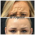 Jeauveau Before and After Ridgeline Aesthetics