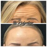 Ridgeline Aesthetics Jeauveau Before and After