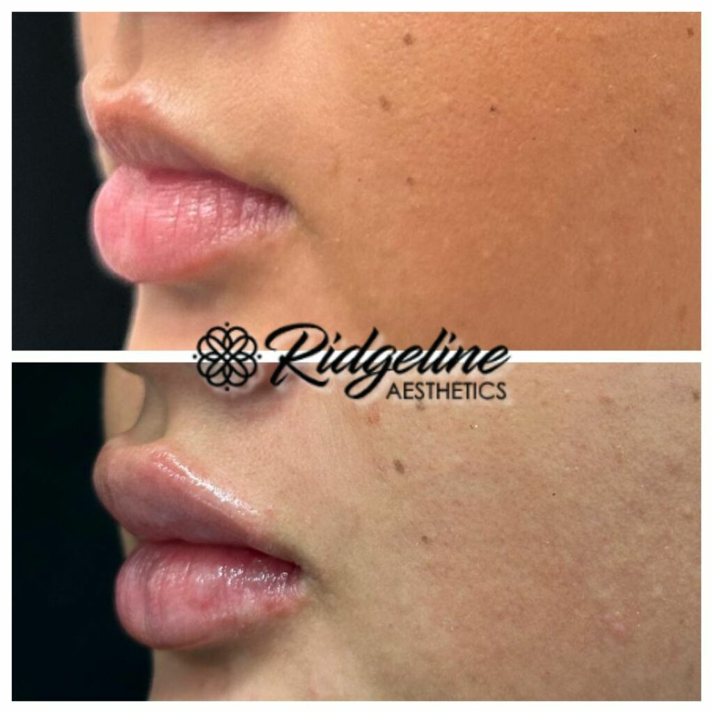 Lip Dermal Fillers, Lip Fillers