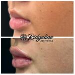 Lip Dermal Fillers, Lip Fillers