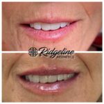 Lip Filler