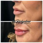 Lip Filler