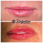 Lip Filler