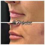 Lip Filler