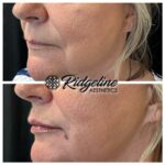 Lip Filler