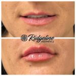 Lip Filler