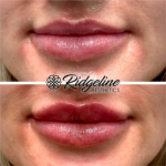 Lip Filler Procedure Before and After Ridgeline Aesthetics