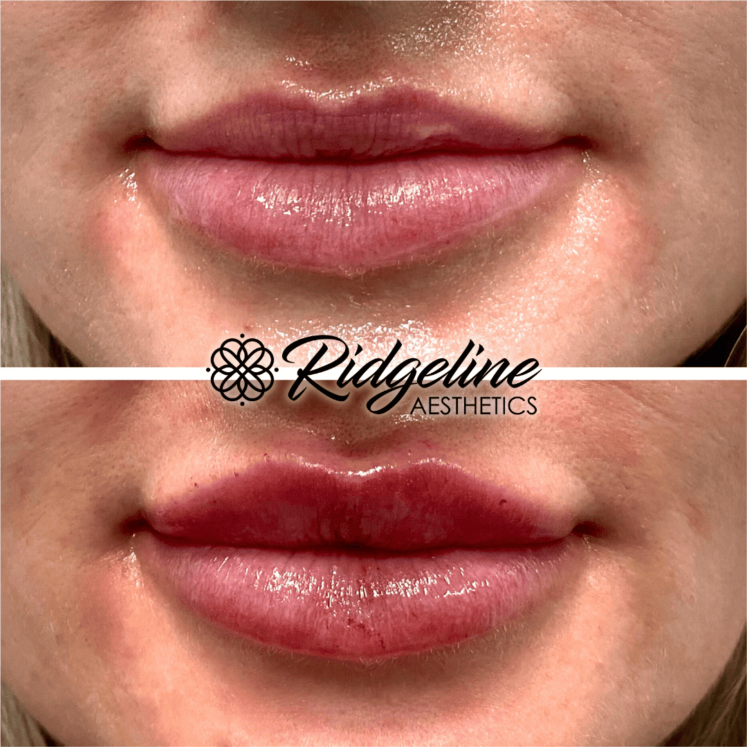 Lip Filler Procedure Before and After Ridgeline Aesthetics
