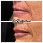 Lip Filler Before and After - Ridgeline Aesthetics