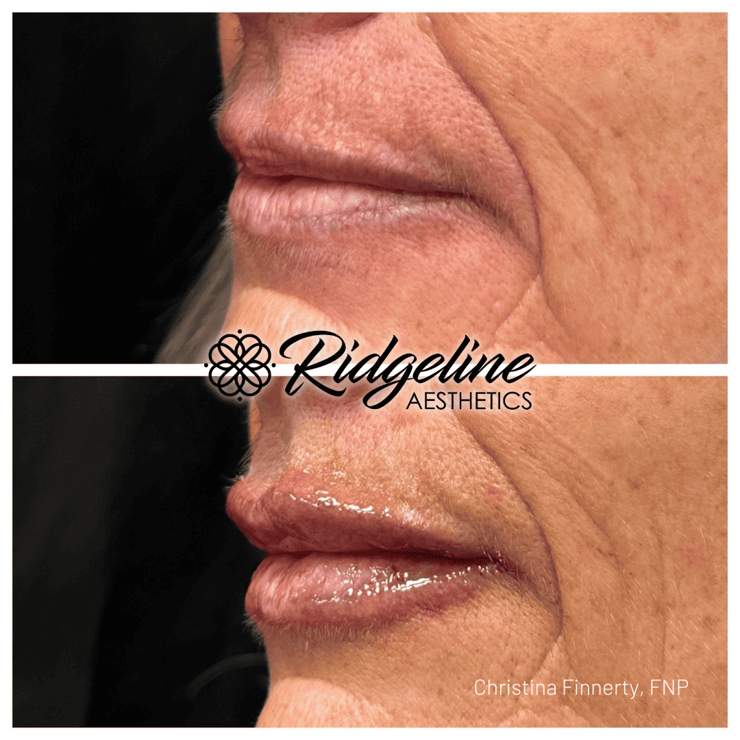 Lip Filler Before and After - Ridgeline Aesthetics