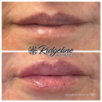 Lip Filler Before and After - Ridgeline