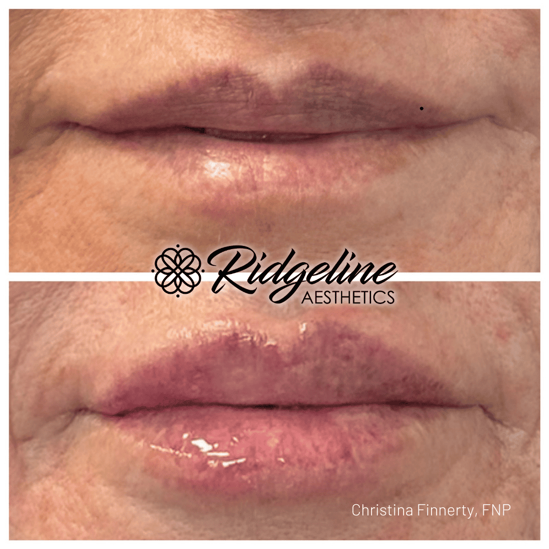 Lip Filler Before and After - Ridgeline