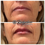 Lip Filler Procedure - Ridgeline Aesthetics