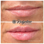Ridgeline Aesthetics Lip Filler Before and After