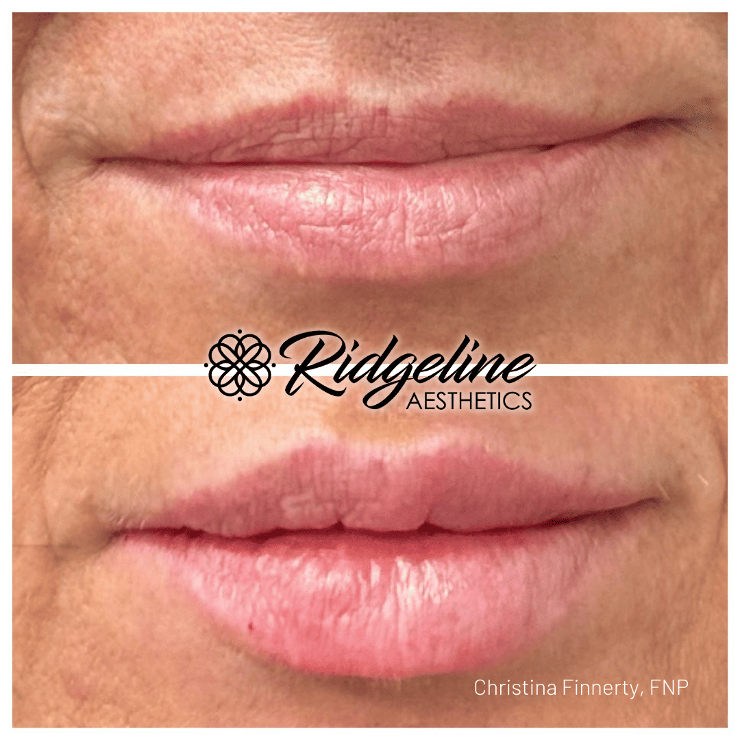 Ridgeline Aesthetics Lip Filler Before and After