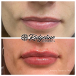 Lip Filler Procedure - Ridgeline