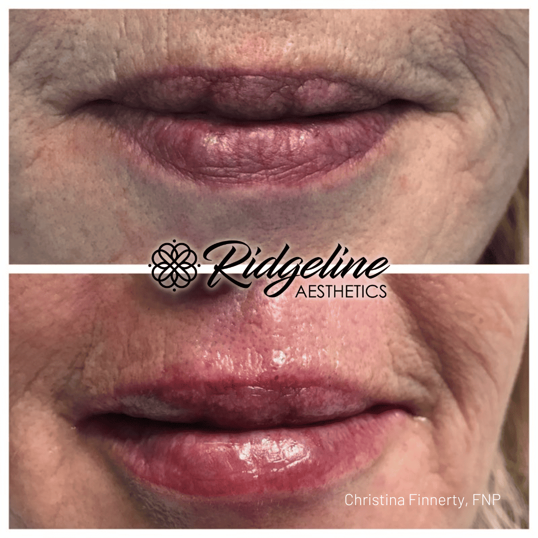 Ridgeline Lip Filler Treatement Before and After