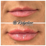 Lip Filler Procedure Ridgeline Aesthetics