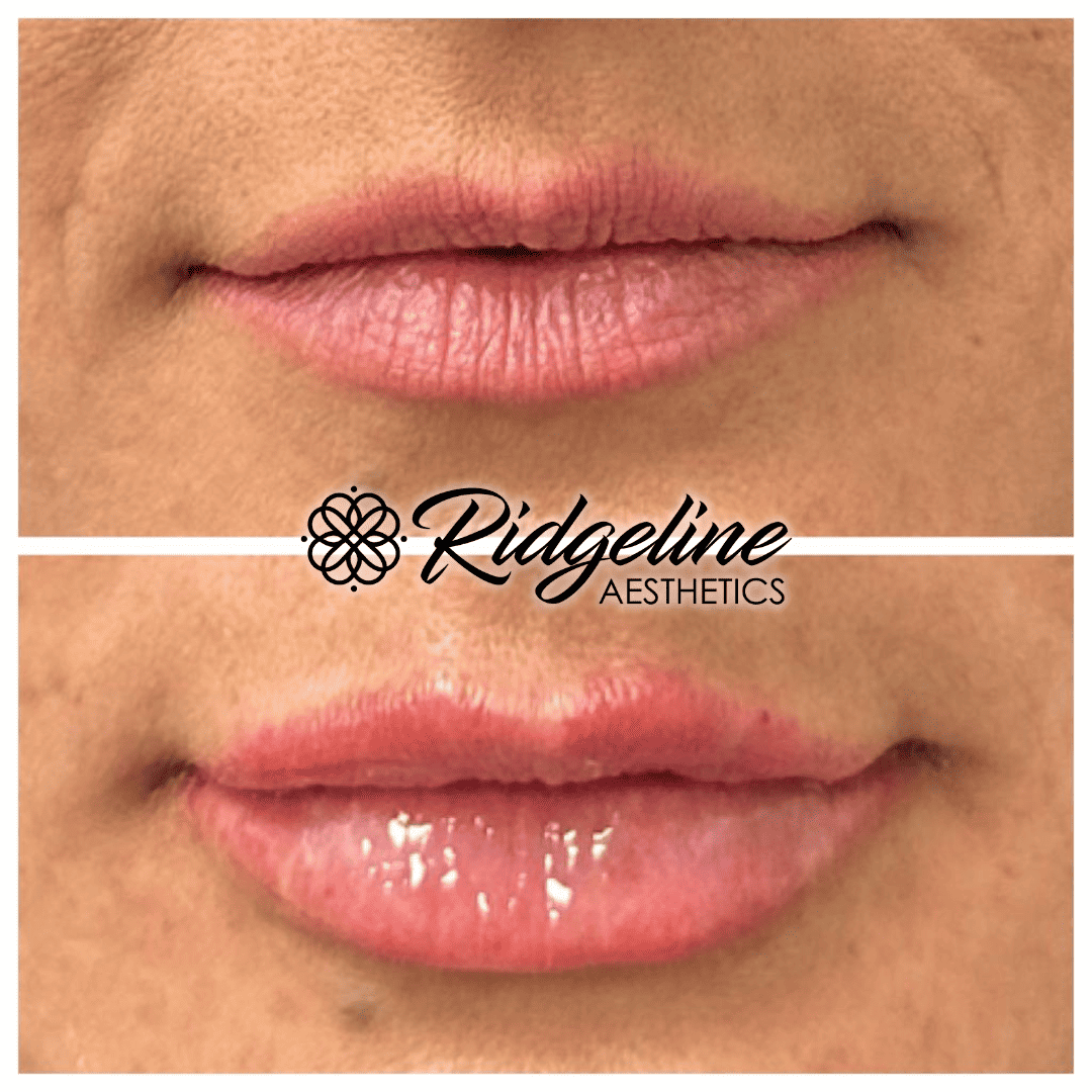 Lip Filler Procedure Ridgeline Aesthetics