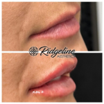 Ridgeline Aesthetics Lip Enhancement Before and After