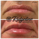 Lip Filler Before and After Ridgeline