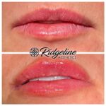 Lip Filler Before and After
