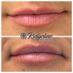 Lip Filler